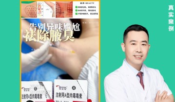 𝐃𝐫 ·李正和院长 别再被狐臭、腋下多汗困扰啦！止汗针💉轻松改善异味案例