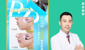 𝐃𝐫 ·李正和院长 芮得怡下巴注射案例｜即刻成型 自然挺翘