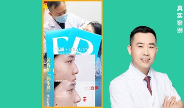 𝐃𝐫 ·李正和院长👨🏻‍⚕️ 濡白天使鼻部填充塑形案例