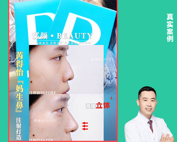 𝐃𝐫 ·李正和院长👨🏻‍⚕️ 濡白天使鼻部填充塑形案例