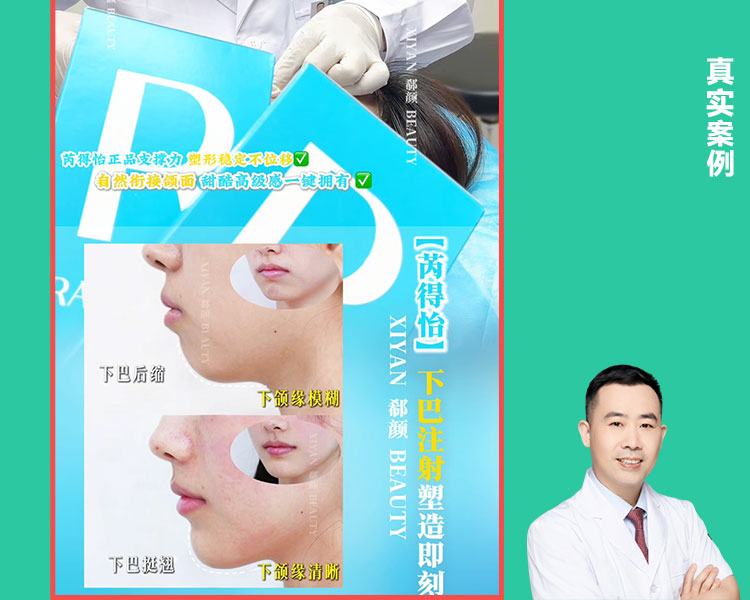 𝐃𝐫 ·李正和院长 芮得怡下巴注射案例｜即刻成型 自然挺翘